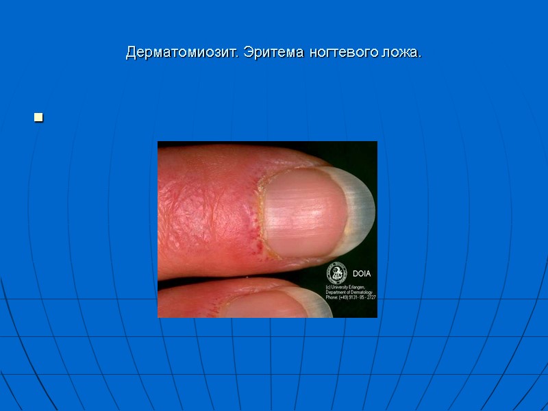 Дерматомиозит. Эритема ногтевого ложа.